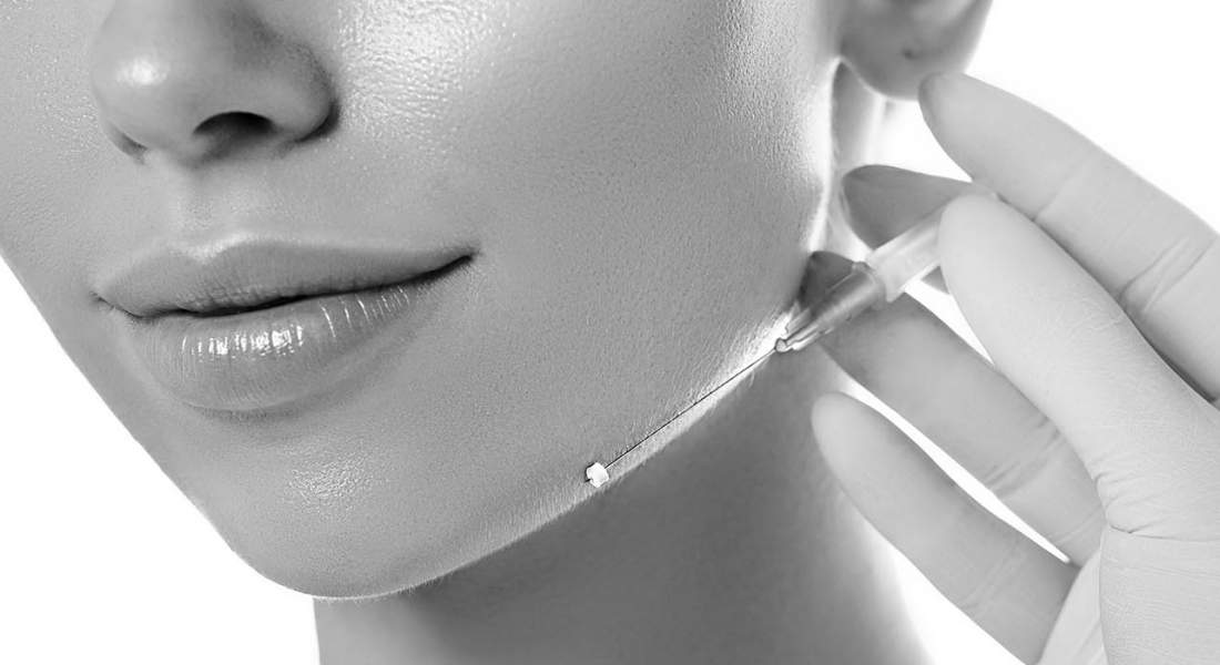 Trådlyft utan kirurgi med trådar